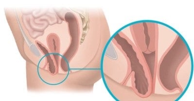 اعراض هبوط المهبل البسيط أنواع مختلفة من هبوط المهبل البسيط