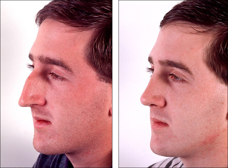 اسعار عمليه تجميل الانف عند الدكتور عبدالكريم فدا
