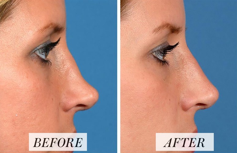 اسعار عمليه تجميل الانف عند الدكتور عبدالكريم فدا