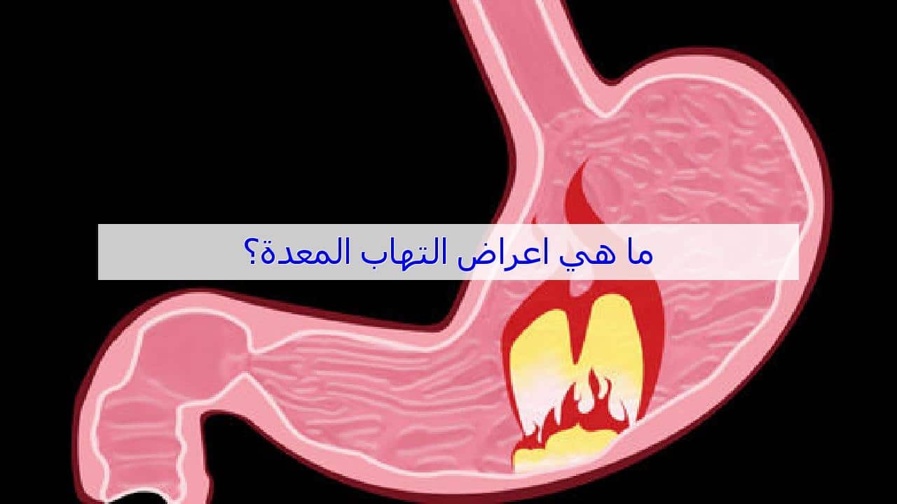 التهاب فم المعدة