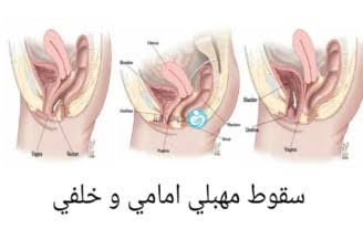  علاج هبوط المهبل بالتمريخ