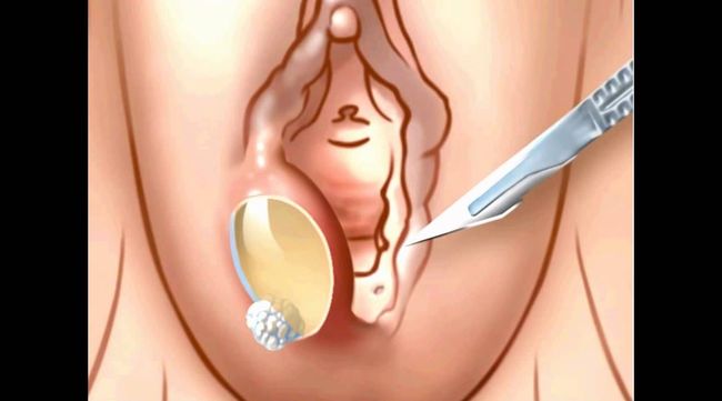 المر لعلاج غدة بارثولين