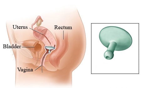 Vaginal pessary علاج هبوط الرحم بدون جراحه